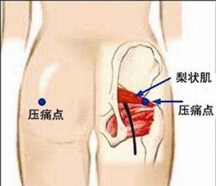 大腿按摩器，大腿肌肉神经疼痛,有什么按摩器可用呢图4