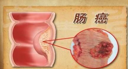 小肠癌的早期症状，肠癌早期有什么症状表现图1