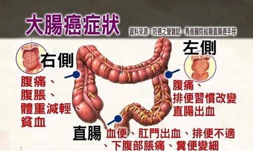 小肠癌的早期症状，肠癌早期有什么症状表现图3