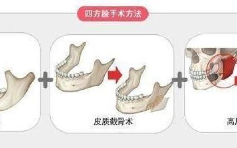 磨腮削骨后遗症，整容脸部削骨后遗症