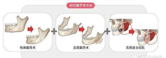 磨腮削骨后遗症，整容脸部削骨后遗症图1