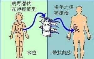 什么叫带状疱疹和单纯疱疹区别图2