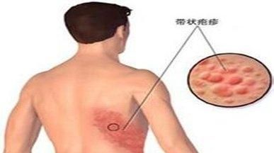 什么叫带状疱疹和单纯疱疹区别图3