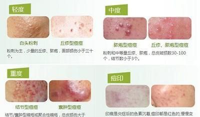 脸颊边长痘怎么办图10