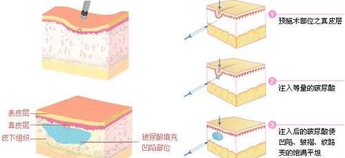 14岁有皱纹该怎么办图7