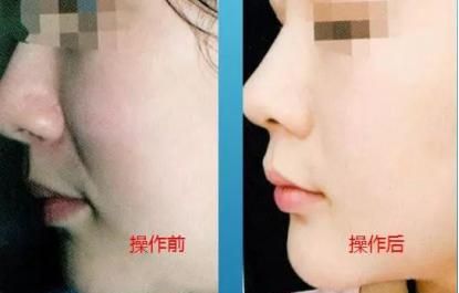 鼻唇沟纹，鼻唇沟和法令纹是一样的吗女生图3