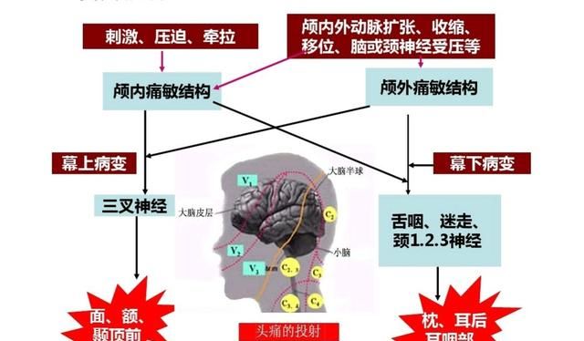 头痛怎么办最快最有效缓解，偏头痛怎么办最快最有效的方法图2