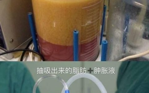 双腿吸脂，大腿吸脂增生是什么