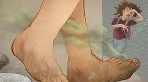 脚臭是什么原因 ，脚臭到底是哪些原因引起的呢图1