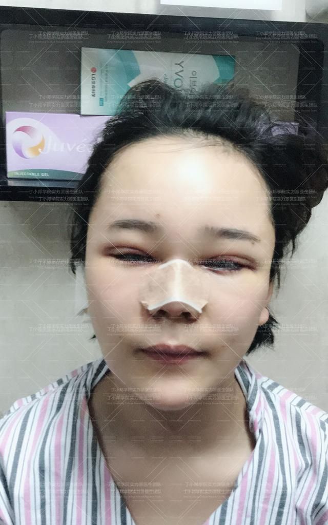 脂肪填充多久能恢复，自体脂肪填充一般可以保持多久图1