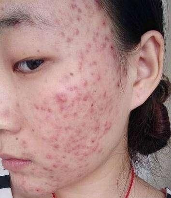 激光嫩肤会反弹吗，激光祛痘会反弹吗图2