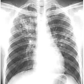什么是肺结核图1