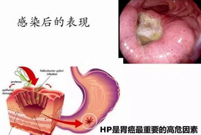 胃痉挛和幽门螺旋杆菌有关系吗图2