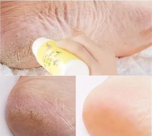脚底出汗，脚底突然多汗是怎么回事?图1