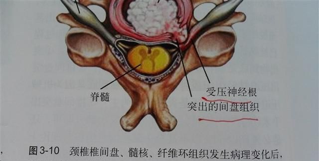 腰椎间盘膨出治疗方案，腰椎间盘膨出能治愈吗?图2