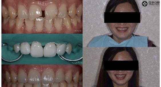 牙齿缺损怎么办，牙齿缺损如何修复图9