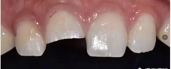 牙齿缺损怎么办，牙齿缺损如何修复图10