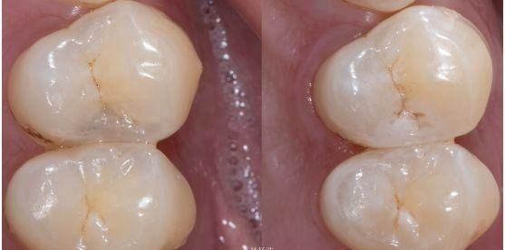 牙齿缺损怎么办，牙齿缺损如何修复图15