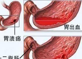 胃穿孔症状，什么是胃穿孔严重吗图5