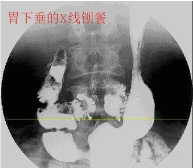 胃下垂的症状，胃下垂是由什么原因引起的图2