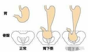 胃下垂的症状，胃下垂是由什么原因引起的图3