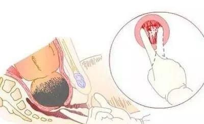 孕妇宫口开到几指才能生产,孕妇宫口开多少才能生图2