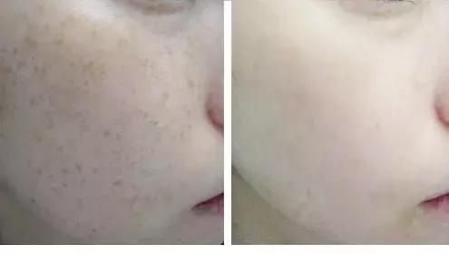 干货｜号称什么皮肤都能治的激光美肤，真有这么强？