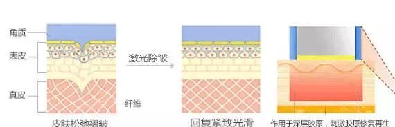 干货｜号称什么皮肤都能治的激光美肤，真有这么强？