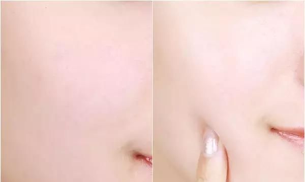 干货｜号称什么皮肤都能治的激光美肤，真有这么强？