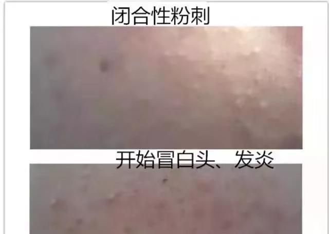 闭合的小粉刺，不能挤的小肉球，你怎么做的？