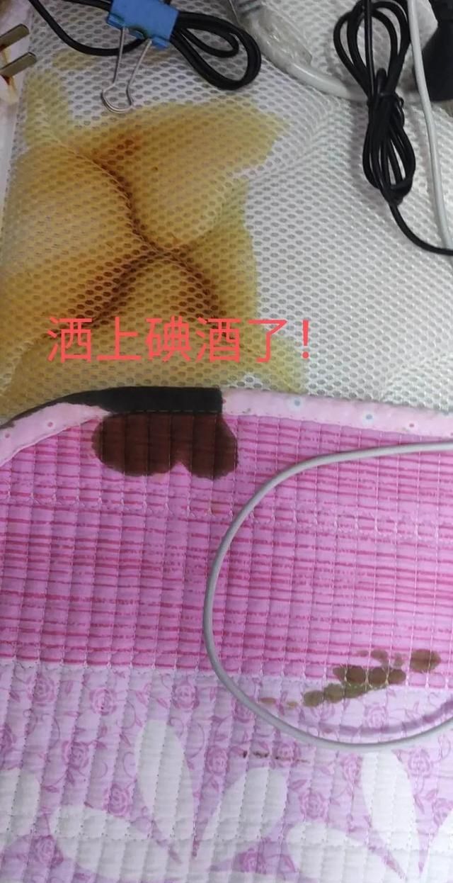 洒在床单上的碘酒洗干净了！