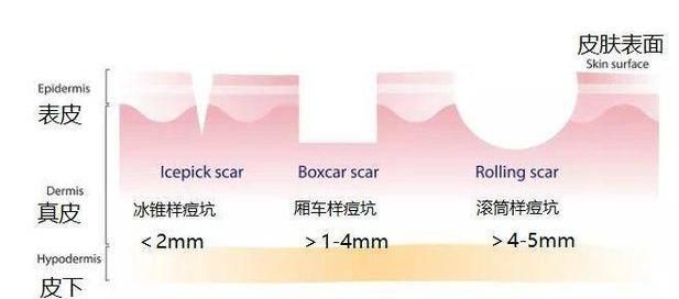 痘坑没救了？先不要乱花钱买护肤品，搞懂平痘坑有哪些方法