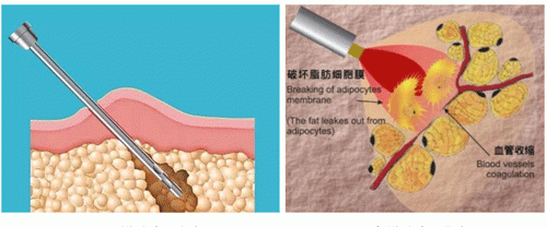 真相来了｜吸脂塑形≠减重，更不是溶脂针