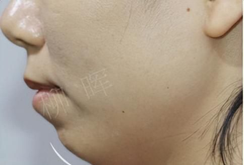 24岁丰下巴体验：玻尿酸不仅解决下巴短小、后缩，还改善了嘴凸