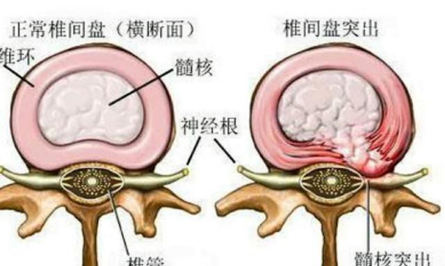 腰间盘突出如何注意饮食图2