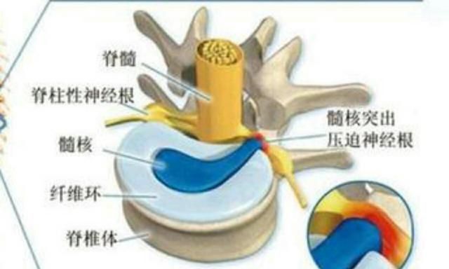 腰间盘突出如何注意饮食图3