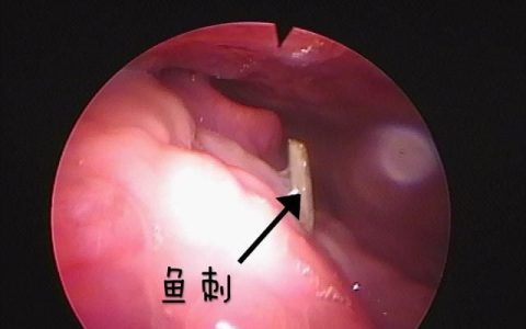 鱼刺卡住吞馒头真的管用吗(鱼刺卡住喉咙吃馒头)