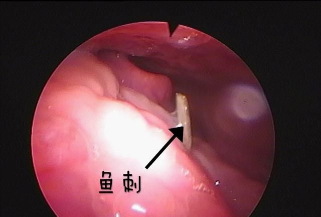 鱼刺卡住吞馒头真的管用吗(鱼刺卡住喉咙吃馒头)图1