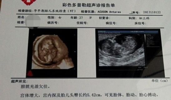 怀孕15周可以做nt检查吗(怀孕做nt15周可以做吗)图6