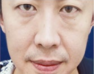 哪些部位适合做电波拉皮除皱,面部电波拉皮除皱价格图2