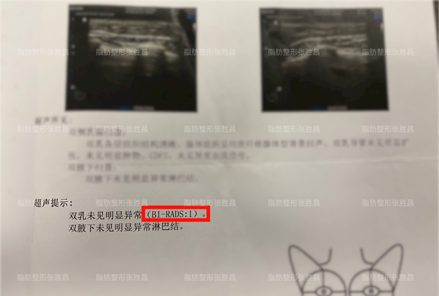 关于“自体脂肪隆胸”的真相你知多少，有乳腺增生不能做此手术？