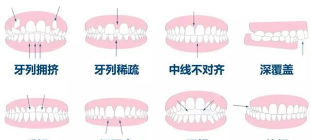 @廊坊人，如果牙齿深覆合怎么办？