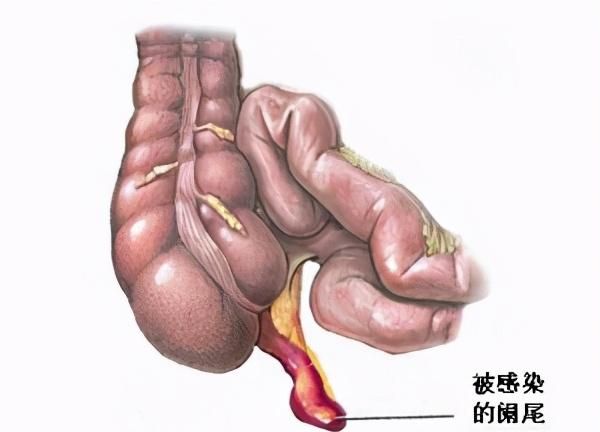 阑尾炎手术治疗，要注意哪些护理事项？