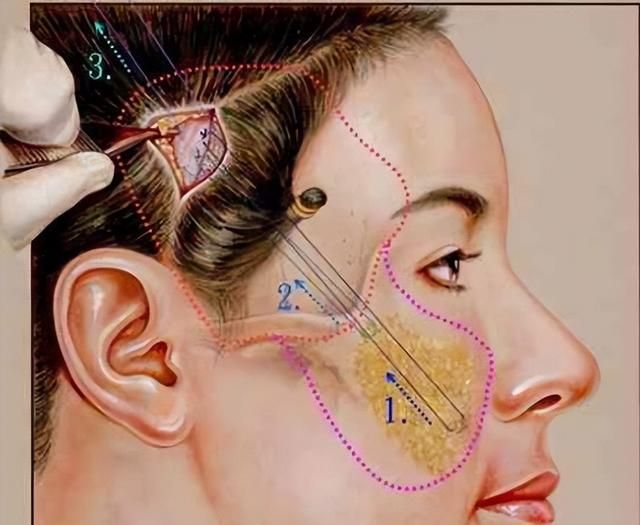 哪种方式面部除皱提升最好？注射、线材提升、拉皮手术？