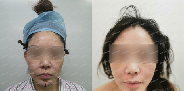 哪种方式面部除皱提升最好？注射、线材提升、拉皮手术？