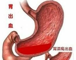 什么是胃出血(胃出血了应该怎么处理)图2