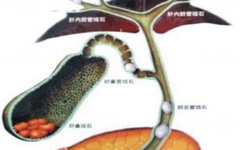 胆结石如何治疗,胆结石如何治