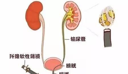 肾结石能不能根治腿上出来的(肾结石做什么治疗)图6