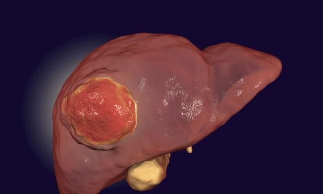 肝癌一期怎么发现的,肝癌早期怎么检查才能发现图1