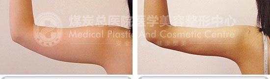 水动力吸脂消除手臂多余脂肪，纤纤玉臂惹人爱